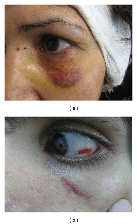 periorbital ecchymosis  subconjunctival hemorrhage  ear