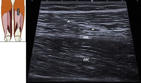 Ultrasound Assessment Of The Hamstrings Complex Of Athletes With Mri Correlation Clinical