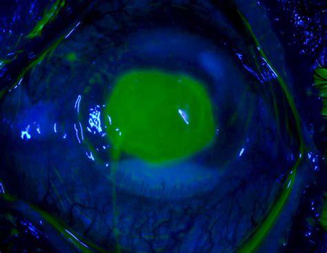 Microbial Keratitis Microbial Keratitis The Corneal Epith Flickr