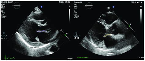 On The Left Plax Parasternal Long Axis View Of A Patient From The