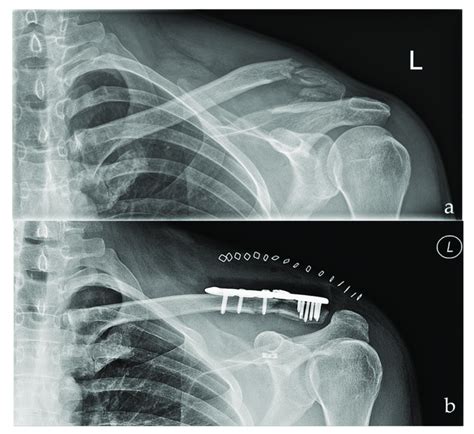 Preoperative A And Postoperative B Radiographs Of A Left Sided