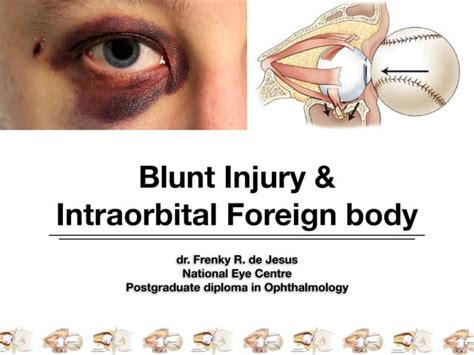 Ocular Blunt Injury Ppt