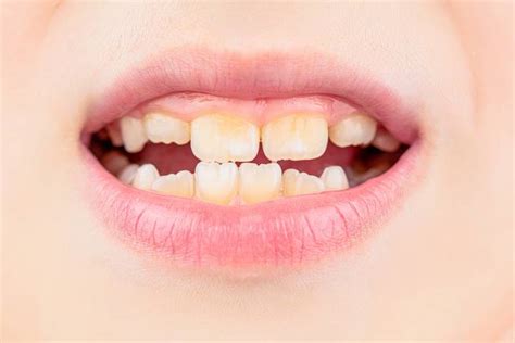 6 Best Child Tooth Decay Treatment Options - Powered by Orange