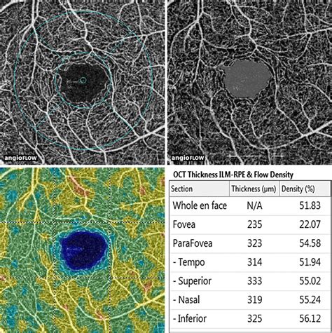 Optical Coherence Tomography Angiography Healthy Subject With Large Download Scientific