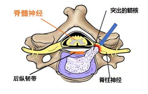 脊髓型颈椎病的中医疗法 健康知识 轻壹