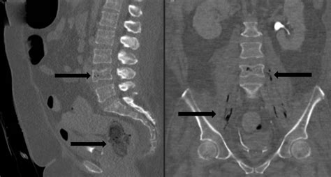 Computed Tomography Scans Of The Abdomen Pelvis With Contrast Shown On