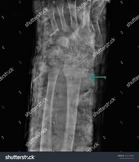 Radiography Forearm Wrist Bones Fracture Distal Stock Photo 1582198486