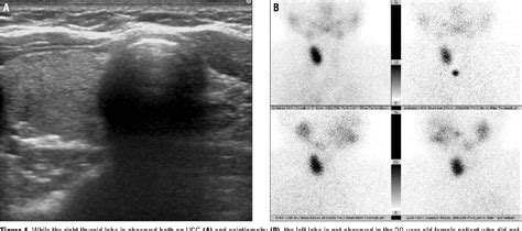 Figure 1 From Three Cases Of Thyroid Gland Left Lobe Hemiagenesis The