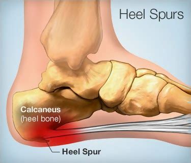 Heel Spur Causes Symptoms And Treatments