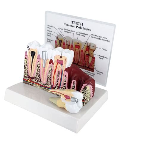 Buy Dental Teeth Model Dental Anatomy Education Tooth Model Pathology