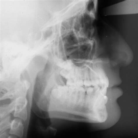 Lateral Cephalometric Radiograph Of Patient When The Transmigrant