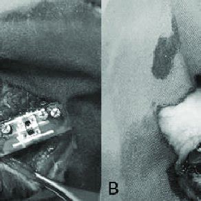 A Application Of The Distractor On Rat Femur Bone B After The