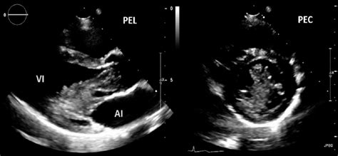 Ecocardiografía transtorácica ETT Panel izquierdo Eje paraesternal