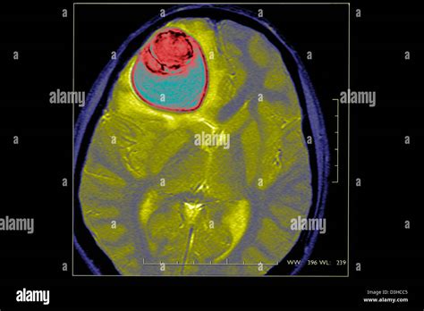 CYST IN THE BRAIN, MRI Stock Photo - Alamy