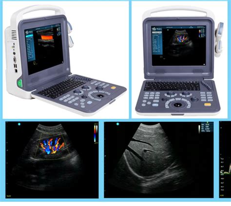 Portable Color Doppler Ultrasound With Two Probes