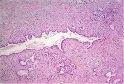 Mesonephric Duct Remnants [26370 and Hyperplasia [72580 - Cell ...