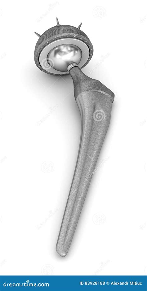 Hip Replacement Implant Medically Accurate 3D Illustration Stock