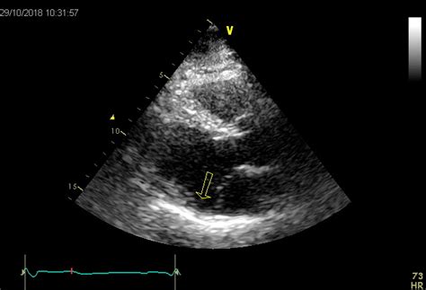 Echovar Eco Del Dia La Disyunci N Del Anillo Mitral