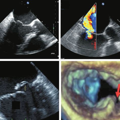 Subvalvular Apparatus A Anatomical Specimen Of Human Mitral Valve