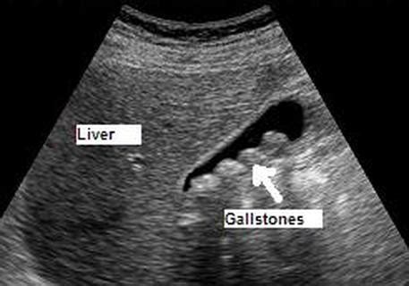 Investigations - GALLSTONES