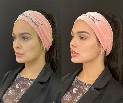 Ex BBB Larissa Santos revela resultado de harmonização facial