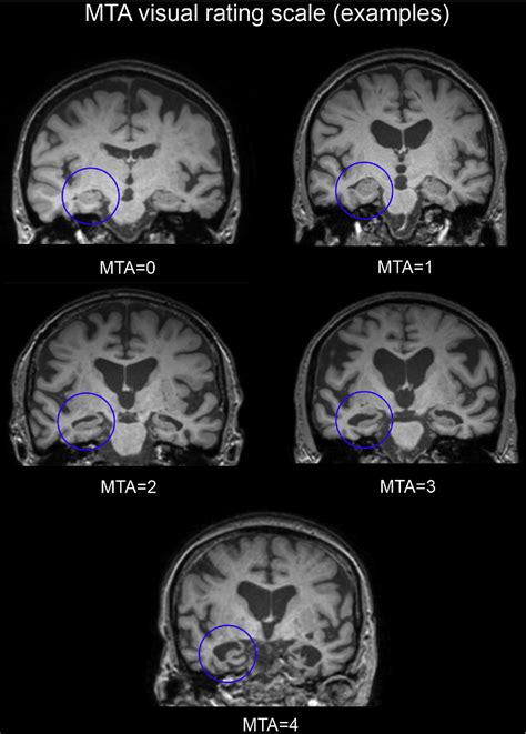 Figure 1 From Multimodal Eeg Mri In The Differential Diagnosis Of