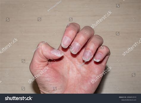 Rough Dry Fingernails