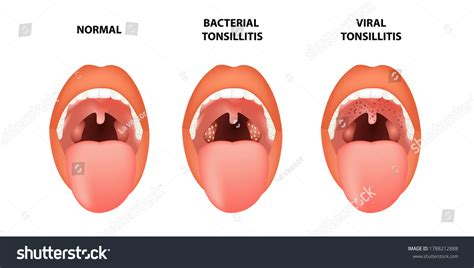 Bacterial Tonsillitis Vs Viral Tonsillitis