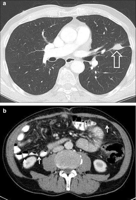 Contrast Enhanced Computed Tomography Scan Of The Chest And Abdomen