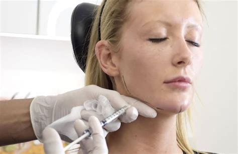 Jawline Contouring Harley Street The Harley Street Filler Specialist