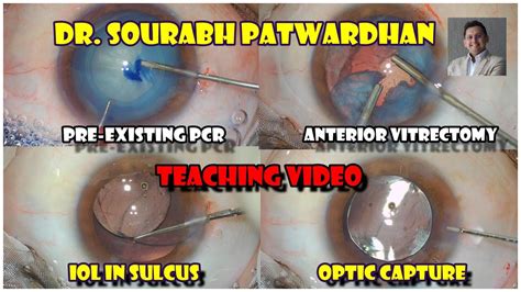 Teaching Video Pcr Anterior Vitrectomy Iol In Sulcus Optic Capture