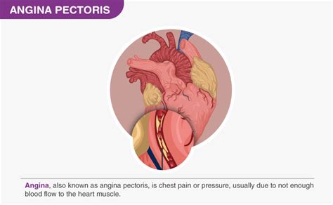 Angina Pectoris- Meaning, Types, Symptoms & Treatment