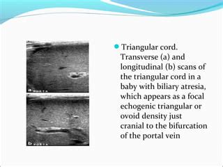 Biliary Atresia Ppt