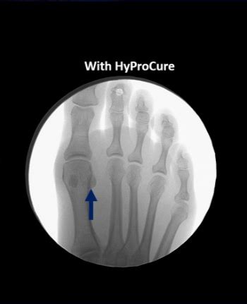 Top Rated Podiatrist For HyProCure In Tuscany