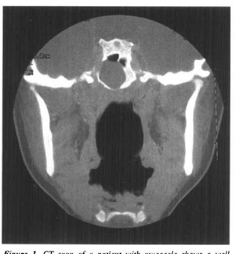 Figure 1 From Isolated Sphenoid Sinus Lesions Semantic Scholar