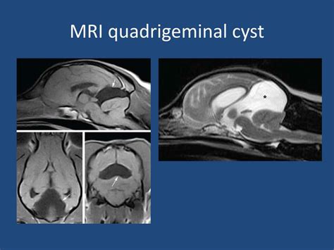 Ppt Quadrigeminal Cysts Powerpoint Presentation Free Download Id