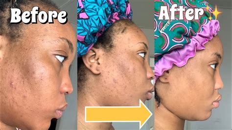 How I Cleared My Acne My Journey To Clear Skin 1 Youtube