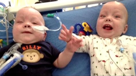 Conjoined Twins 9 Hour Surgery Separates Owen And Emmett Ezell Good Morning America