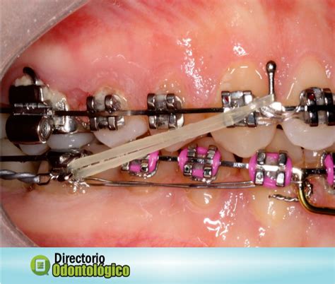 ORTODONCIA Cómo funcionan los Elásticos Intermaxilares Directorio