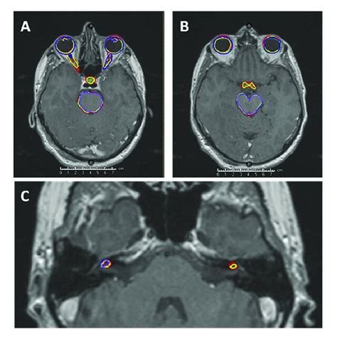 T1 Weighted Gadolinium Enhanced MRI Showing Examples Of The Predicted