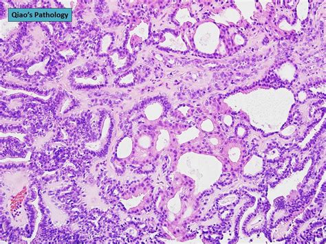 Qiao S Pathology Intraductal Papilloma Of The Breast With Apocrine