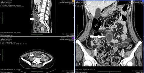 Figure From An Unusual Case Of Intraabdominal Abscess And Acute