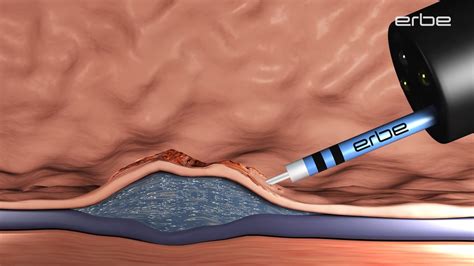 Endoscopic Submucosal Dissection Esd Using Hybridknife® Medical Videos