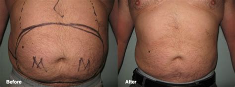 Lipo Photo Gallery Smart Lipo Cleveland