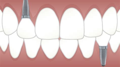 Surprising Facts About Dental Implants GuideByTips