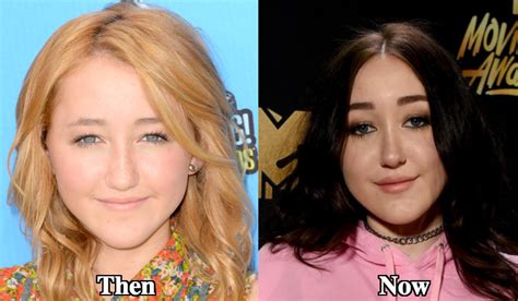 Noah Cyrus Plastic Surgery Before and After Photos - Latest Plastic ...