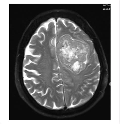 Magnetic Resonance Imaging Of Brain At Initial Presentation Download Scientific Diagram