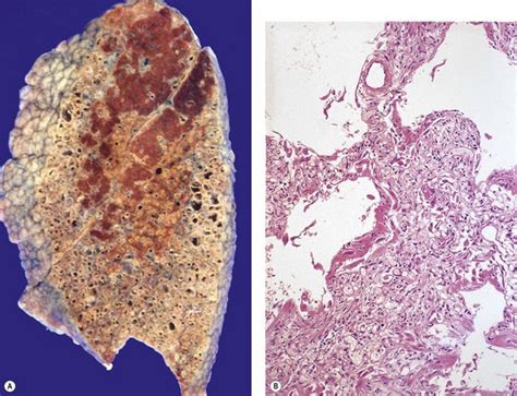 Parenchymal Disease Of The Lung Basicmedical Key