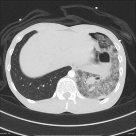 Pneumatocele Radiology Reference Article Radiopaedia Org