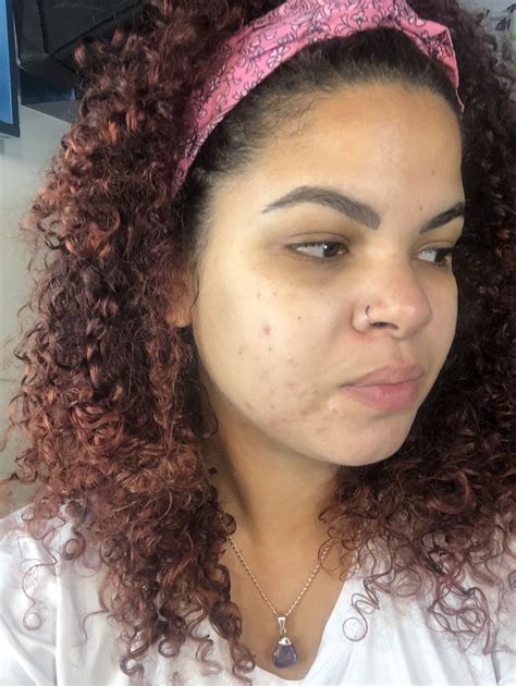 Mapa da Acne: entenda o que significam em cada região do rosto | Acne